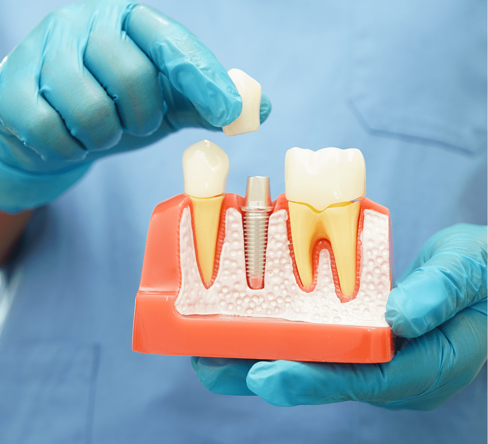 Dental Implant Restoration Services Massillon Ohio Boss Family Dentistry