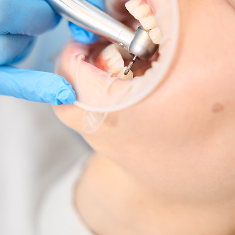 dental filling and bonding massillon dentist boss family dentistry dental filling and bonding massillon dentist boss family dentistry