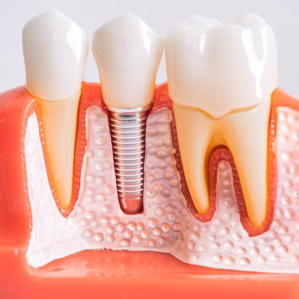 implant supported restoration massillon dentist boss family dentistry implant supported restoration massillon dentist boss family dentistry